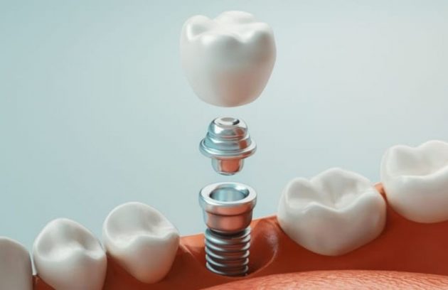 dental implants colorado springs